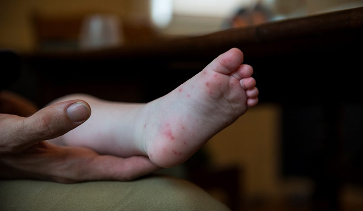 Hand, Foot & Mouth Disease ( HFMD )